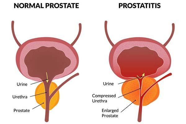 What is prostatitis and how is it treated?